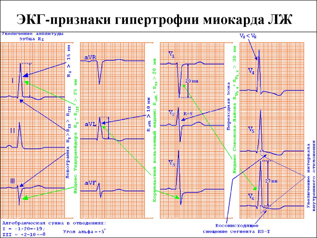 Диастолическая перегрузка левого желудочка на экг картинка