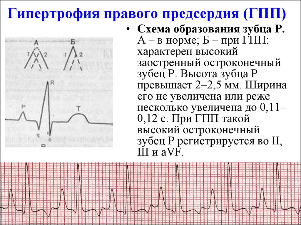 Диастолическая перегрузка левого желудочка на экг картинка