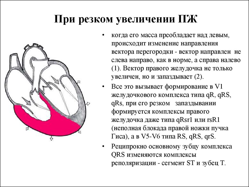 Дилатация предсердий. Гипертрофия отделов сердца. Увлечение правого желудочка. Изменение желудочка сердца. Расширение правых отделов сердца.