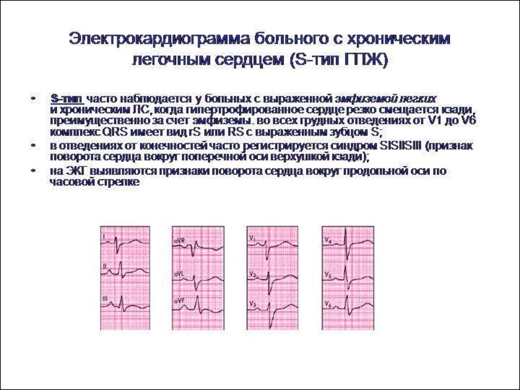 Типы экг. ЭКГ при хроническом легочном сердце. Изменения ЭКГ при хроническом легочном сердце. ЭКГ критерии легочного сердца. ЭКГ признаки ХЛС.