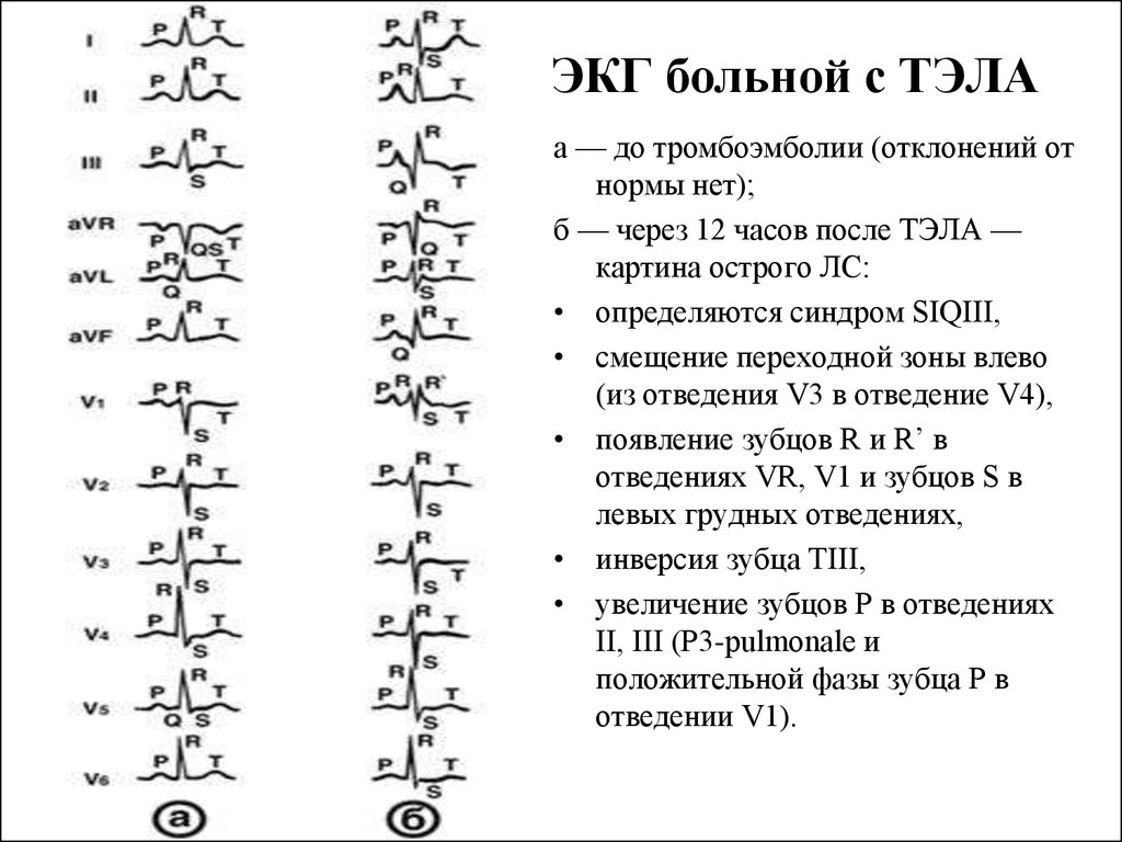 Экг при тэла фото