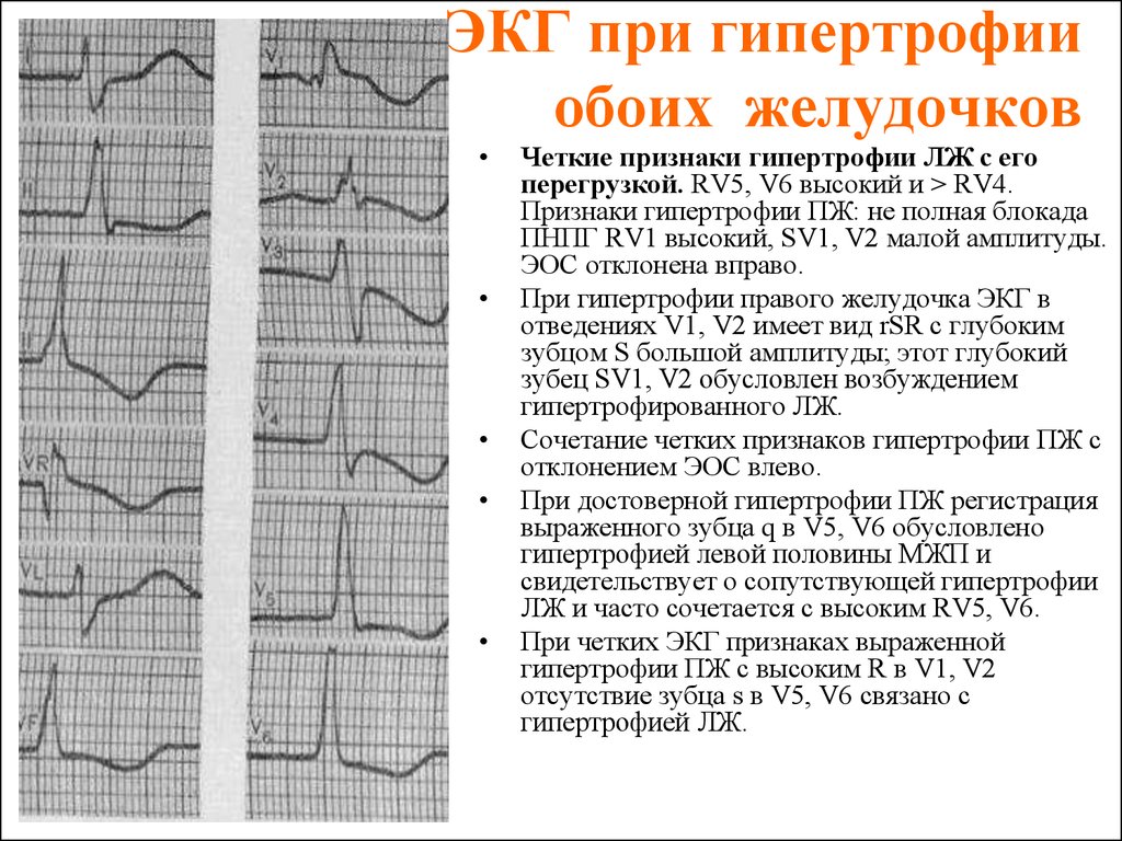 Изменения миокарда левого желудочка сердца. Гипертрофия правого желудочка на ЭКГ. Электрокардиограмма при гипертрофии желудочков. Гипертрофия левого и правого желудочка на ЭКГ. Гипертрофия левого и правого желудочка сердца на ЭКГ.
