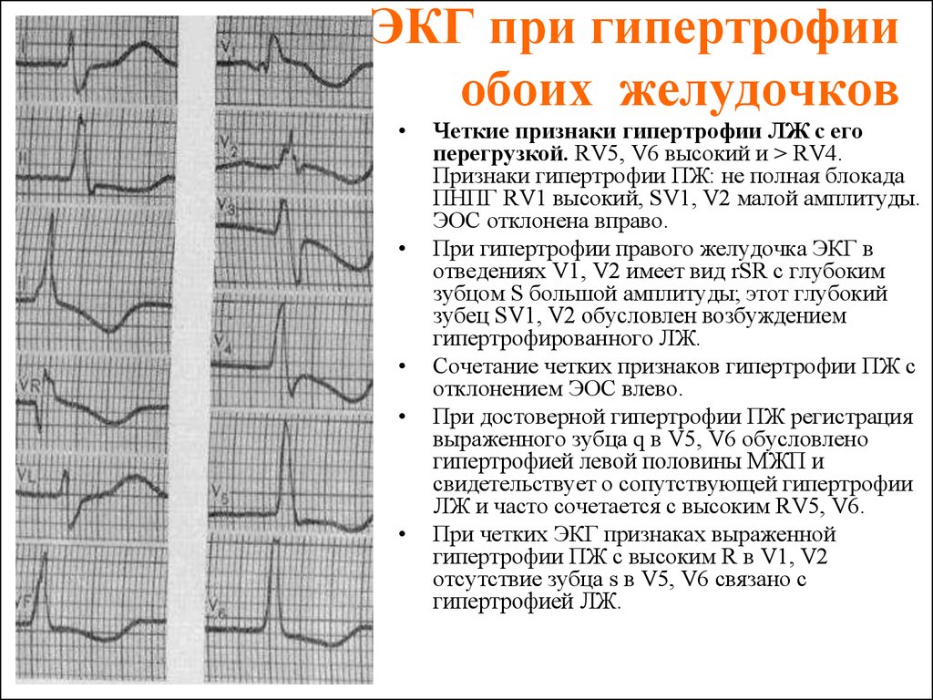 Диастолическая перегрузка левого желудочка на экг картинка