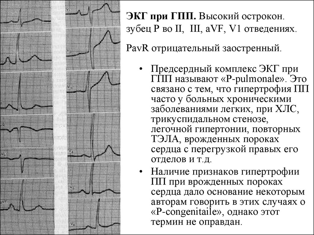 Отведение v1 на экг. Отрицательный зубец р после QRS комплекса. Отрицательный зубец р в 3 отведении на ЭКГ. ЭКГ высокий зубец r в v1-v2. В нормальной ЭКГ зубец р в v1.