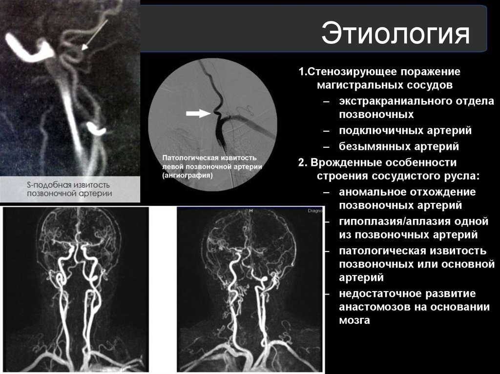 Гипоплазия правой головного мозга. Гипоплазия v4 позвоночной артерии. Гипоплазия v4 сегмента правой позвоночной артерии. Гипоплазия позвоночной артерии мрт. Аплазия позвоночной артерии мрт.