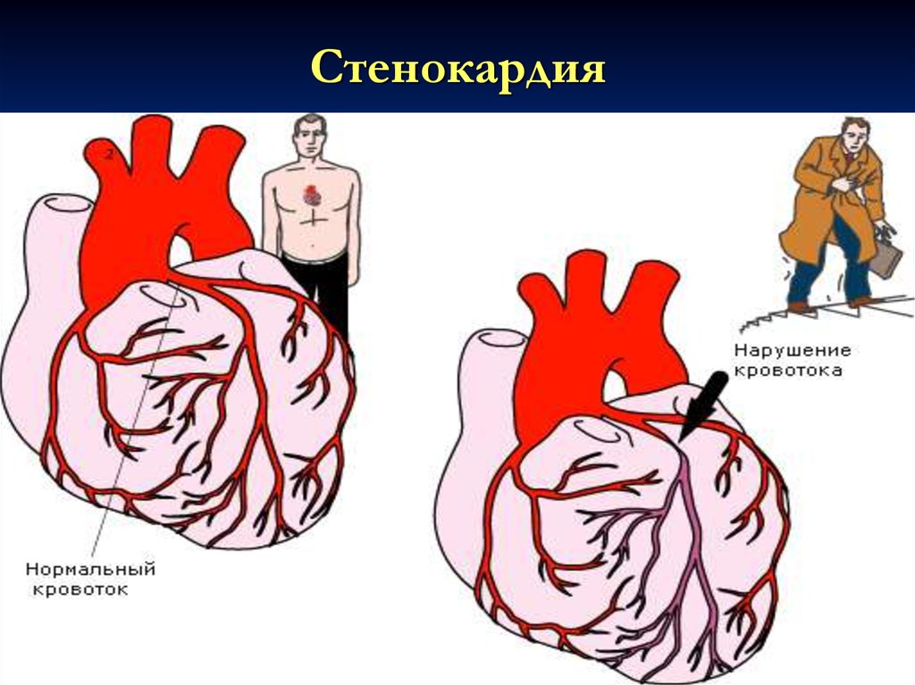 Стенокардия. Стабильная стенокардия. Стенокардия картинки. Стабильная ИБС.