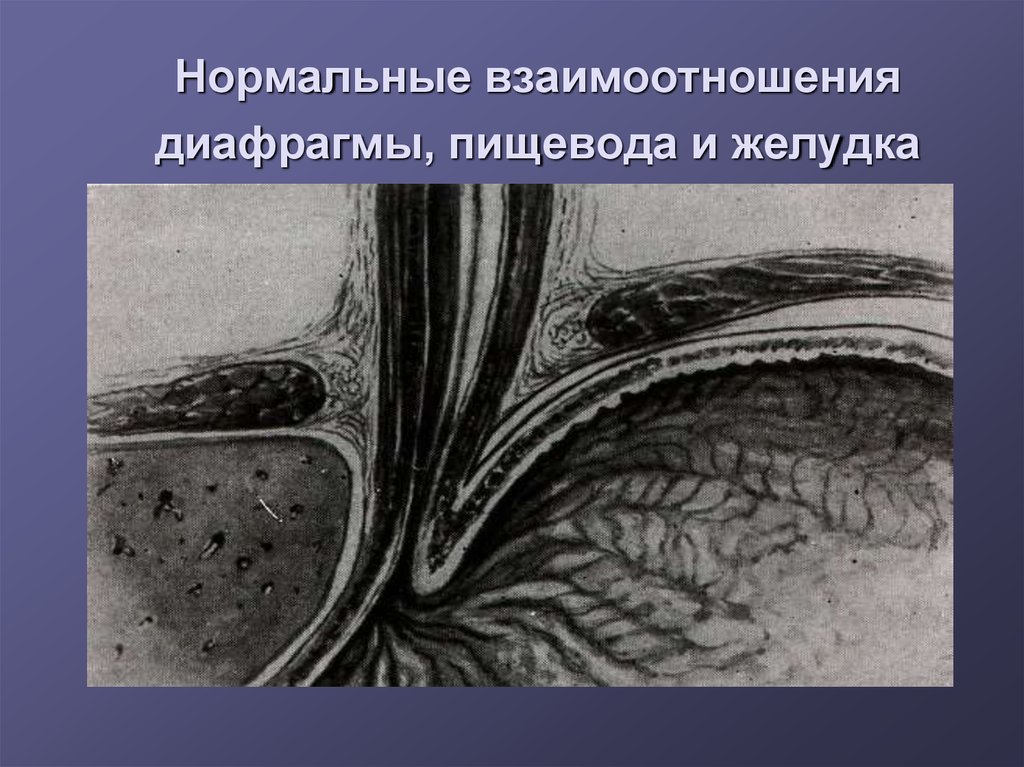 Грыжа кардии. Грыжа диафрагмы пищевода. Ахалазия пищевода гистология.