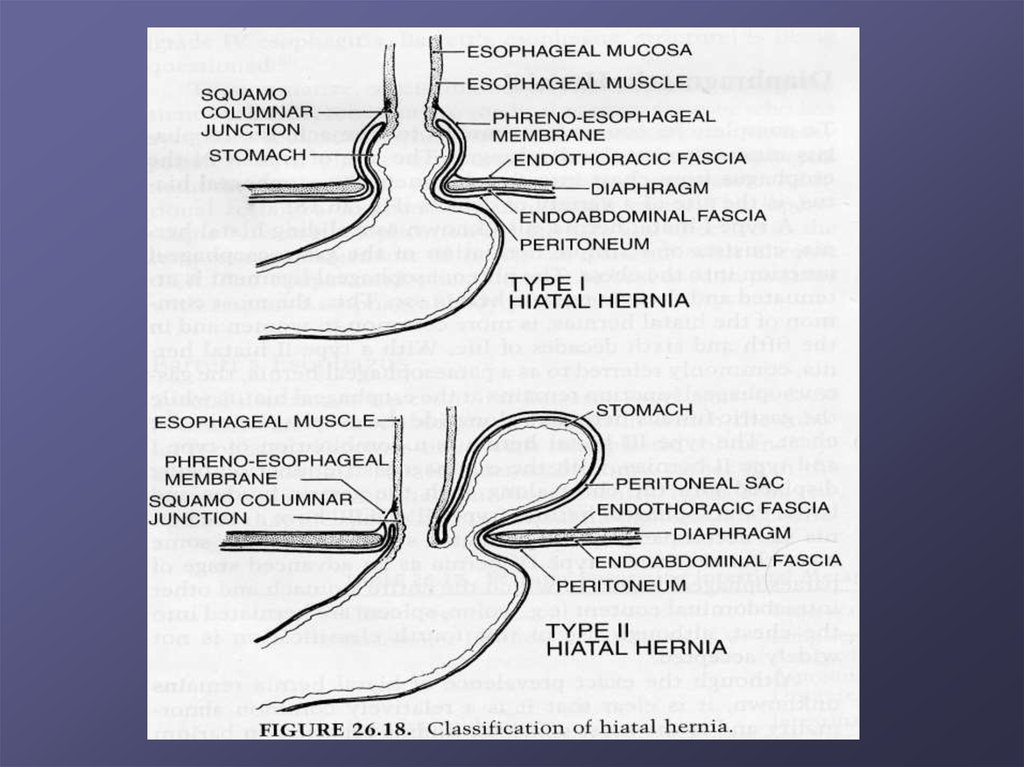 Грыжа кардии. Грыжа презентация хирургия. Грыжа живота классификация. Ахалазия кардии презентация хирургия.