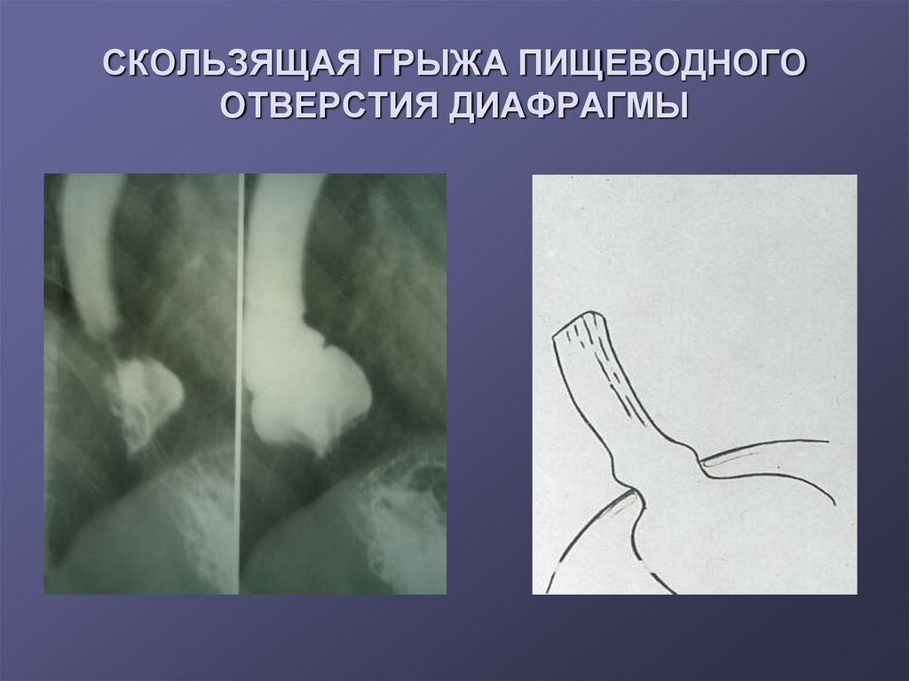 Грыжи пищеводного отверстия диафрагмы презентация по хирургии