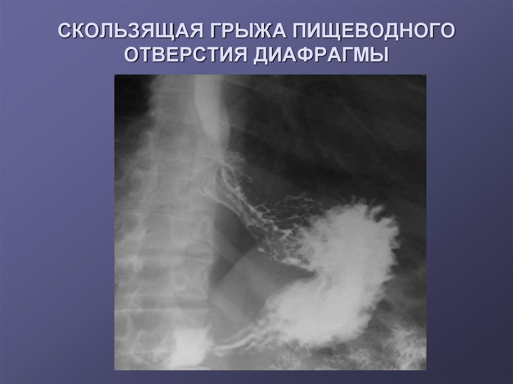 Грыжа под. Грыжа диафрагмы пищевода рентген. Скользящая грыжа пищевода рентген. Скользящая грыжа пищеводного отверстия диафрагмы.