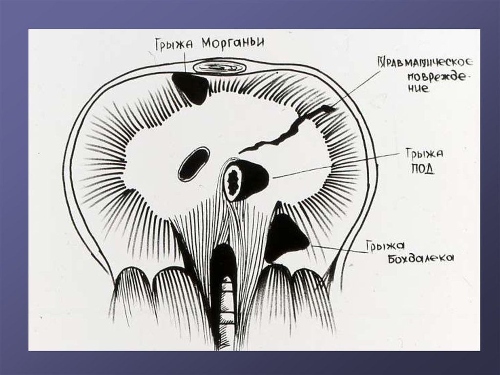 Грыжа бохдалека. Грыжи Ларрея Морганьи и Бохдалека. Грыжи диафрагмы Ларрея. Грыжа Ларрея Морганьи диафрагмы. Грыжа Ларрея – Морганьи–ретрокостостернальная грыжа.
