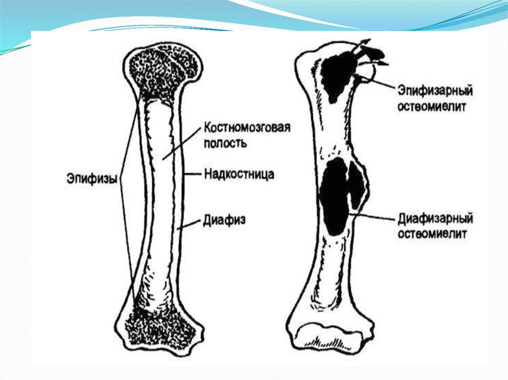 Эпифизарный остеомиелит у детей презентация