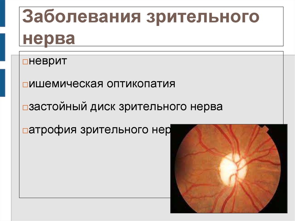 Поражение зрительного. Клинические признаки поражения зрительного нерва. Нарушение зрительного нерва симптомы. Неврит зрительного нерва лекарства. Заболевания диска зрительного нерва.