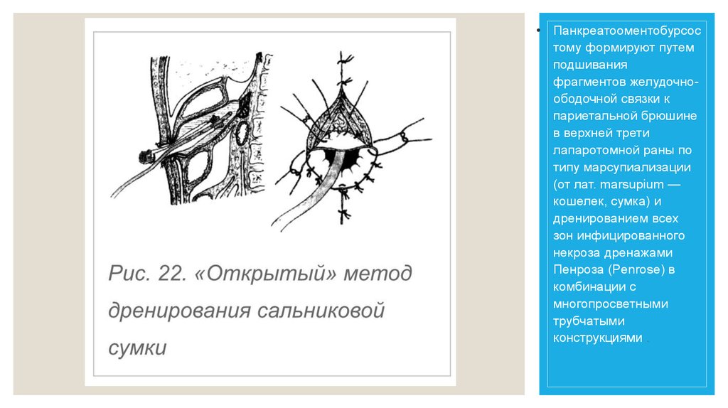 Открой метод. Открытый метод дренирующих операций. Открытый метод дренирования при панкреонекрозе. Методы дренирования при панкреонекрозе. Дренирование сальниковой сумки при остром панкреатите.