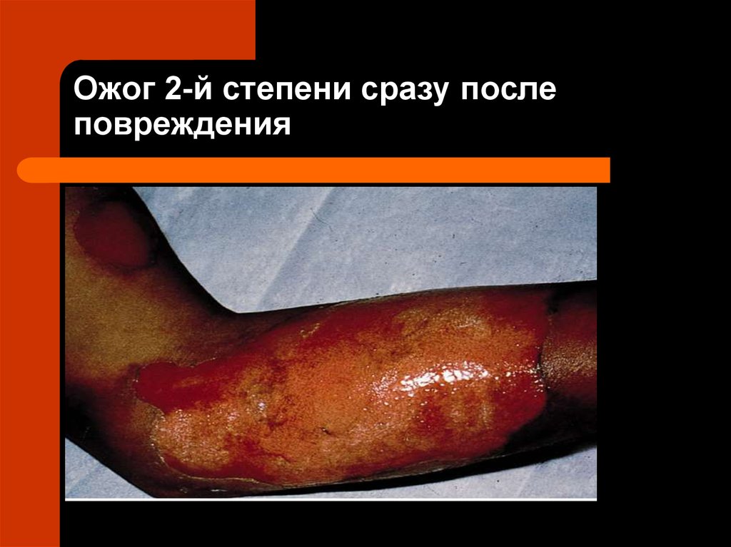 Ожог 2-й степени сразу после повреждения