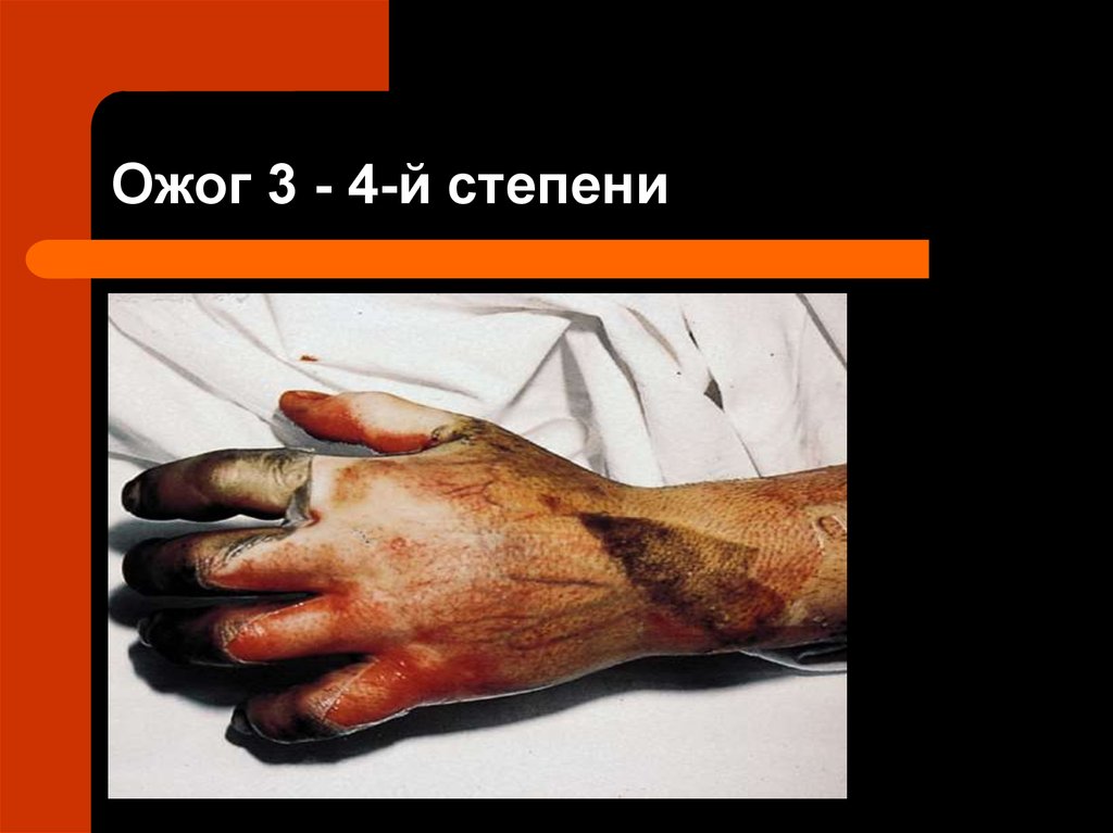 Ожог 3 - 4-й степени