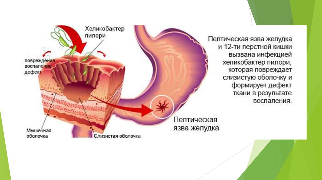 Кофе при язве желудка. Этиология болезни 12 перстной кишки. Язва желудка и 12 перстной кишки. Язвенная болезнь луковицы двенадцатиперстной патогенез.