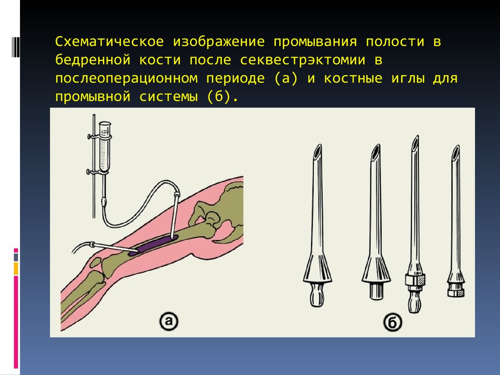 Почистили кость. Декомпрессионная остеоперфорация. Операция при остеомиелите. Операции при остром остеомиелите.