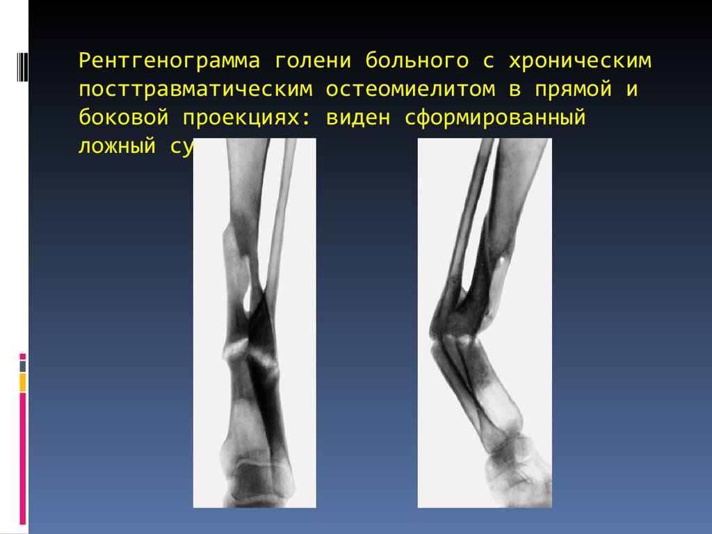 Хронический остеомиелит картинки