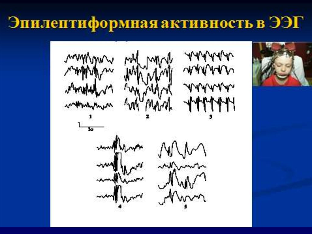 Диффузные эпилептиформные