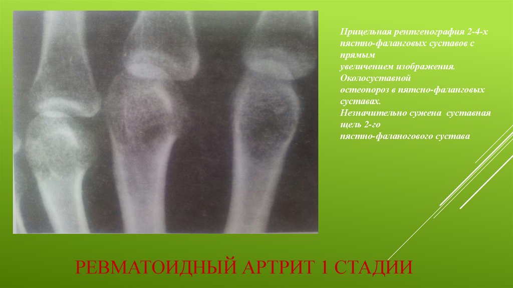 Артрит фаланговых суставов. Рентген при ревматоидном артрите 1 стадии. Ювенильный артрит коленного сустава рентген. Заключение остеопороз коленного сустава рентген. Ревматоидный артрит коленного сустава рентген картина.