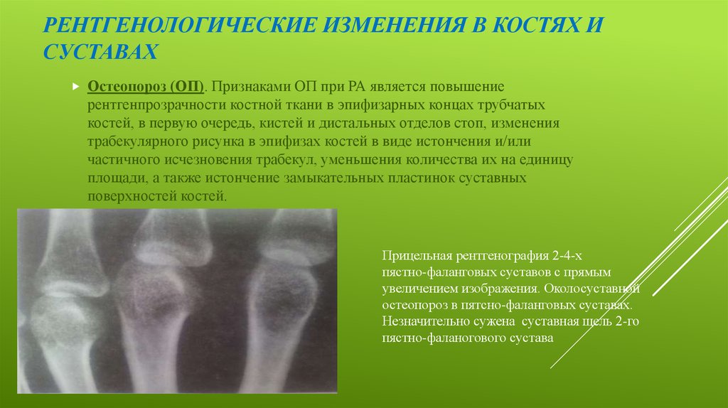 Признаком возрастных изменений костей является. Ревматоидный артрит 1 стадия на рентгене. Рентгенологические признаки ревматоидного артрита. Артрит кистей 1 степени рентген. Эпифизарный остеопороз костей кистей.