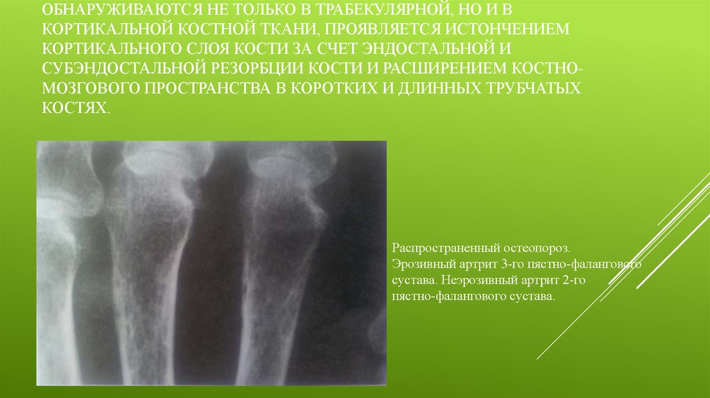 Изменения в костях. Лакунарная резорбция костной ткани. Эндостальная резорбция костной ткани.