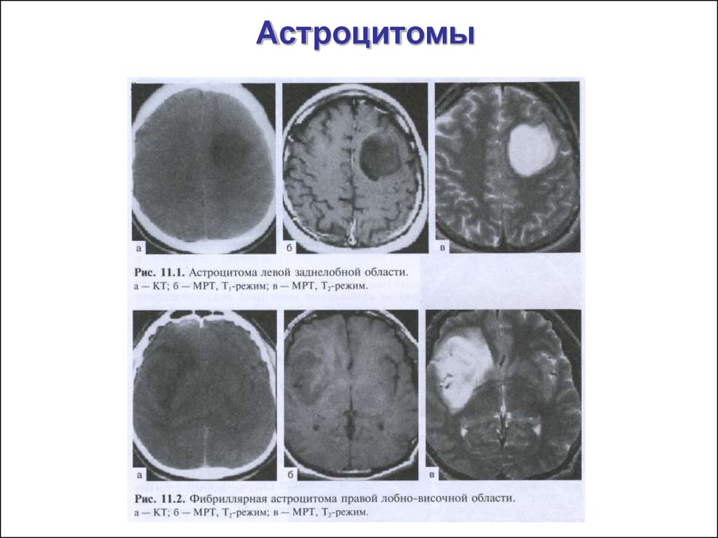 Астроцитома грейд. Анапластическая астроцитома кт. Анапластическая астроцитома лобной доли. Астроцитома головного мозга кт. Мультифокальная астроцитома.