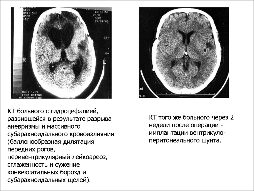 Мр картина перивентрикулярной лейкопатии