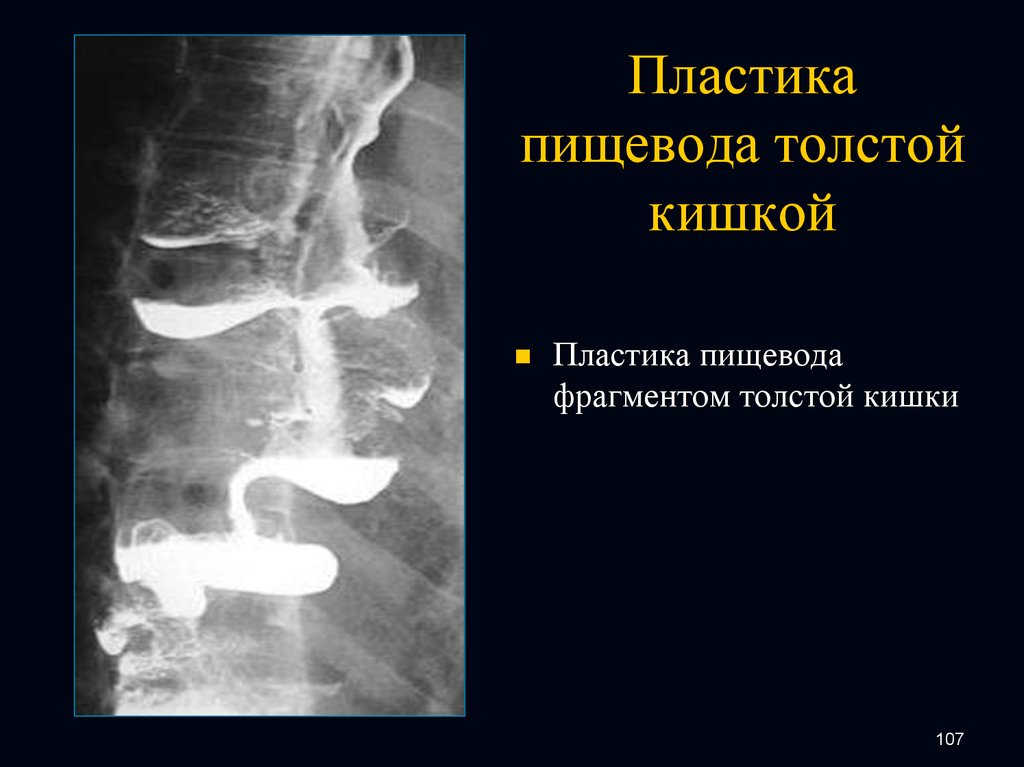 Тонкая кишка пластика