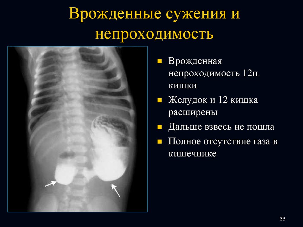 Врожденная кишечная. Непроходимость 12 перстной кишки рентген. Непроходимость ДПК рентген. Врожденная кишечная непроходимость рентгенография. Врожденная высокая кишечная непроходимость рентген.