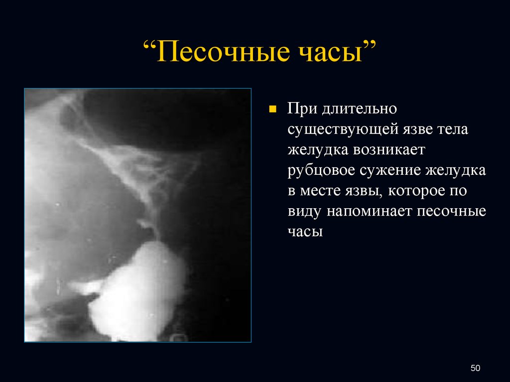 Часы желудка. Деформация желудка по типу песочных часов рентген. Деформация желудка по типу песочных часов. Деформация желудка в виде песочных часов. Песочные часы желудок рентген.