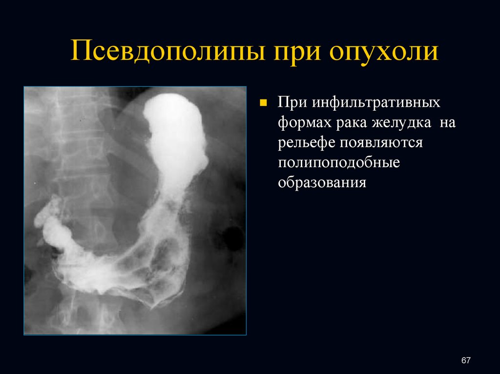 Формы рака пищевода