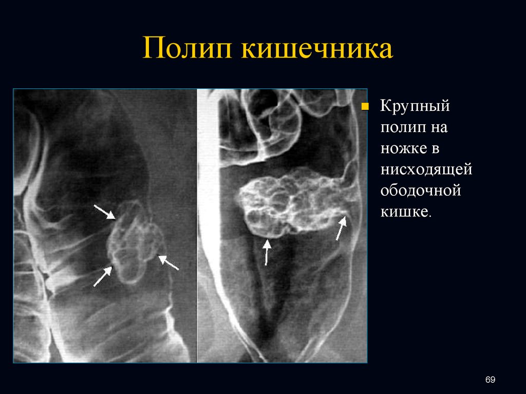 Выпадение полипа прямой кишки фото