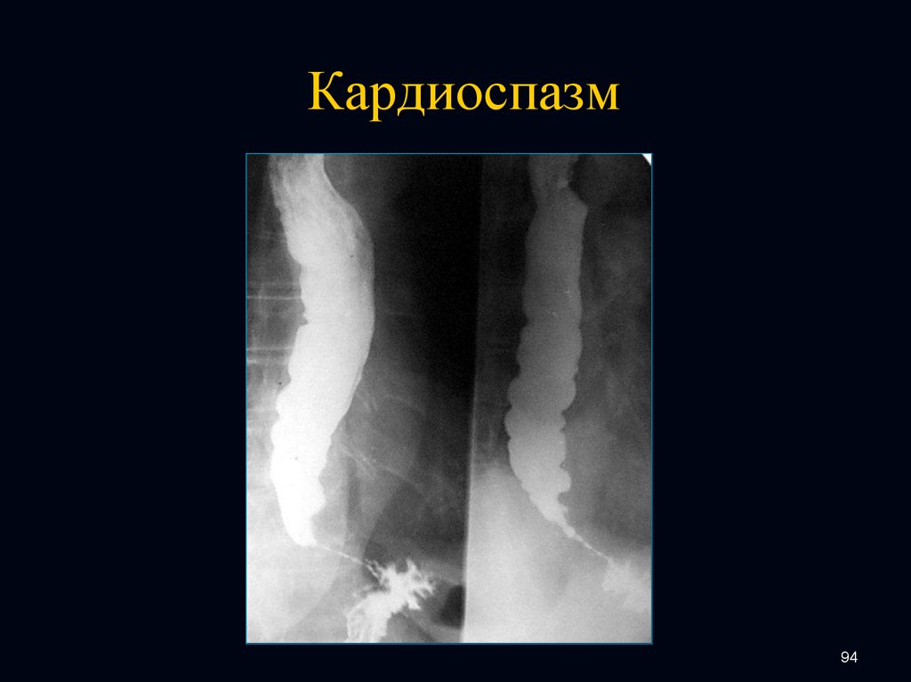 Рентгенологическая картина ахалазии пищевода при контрастировании