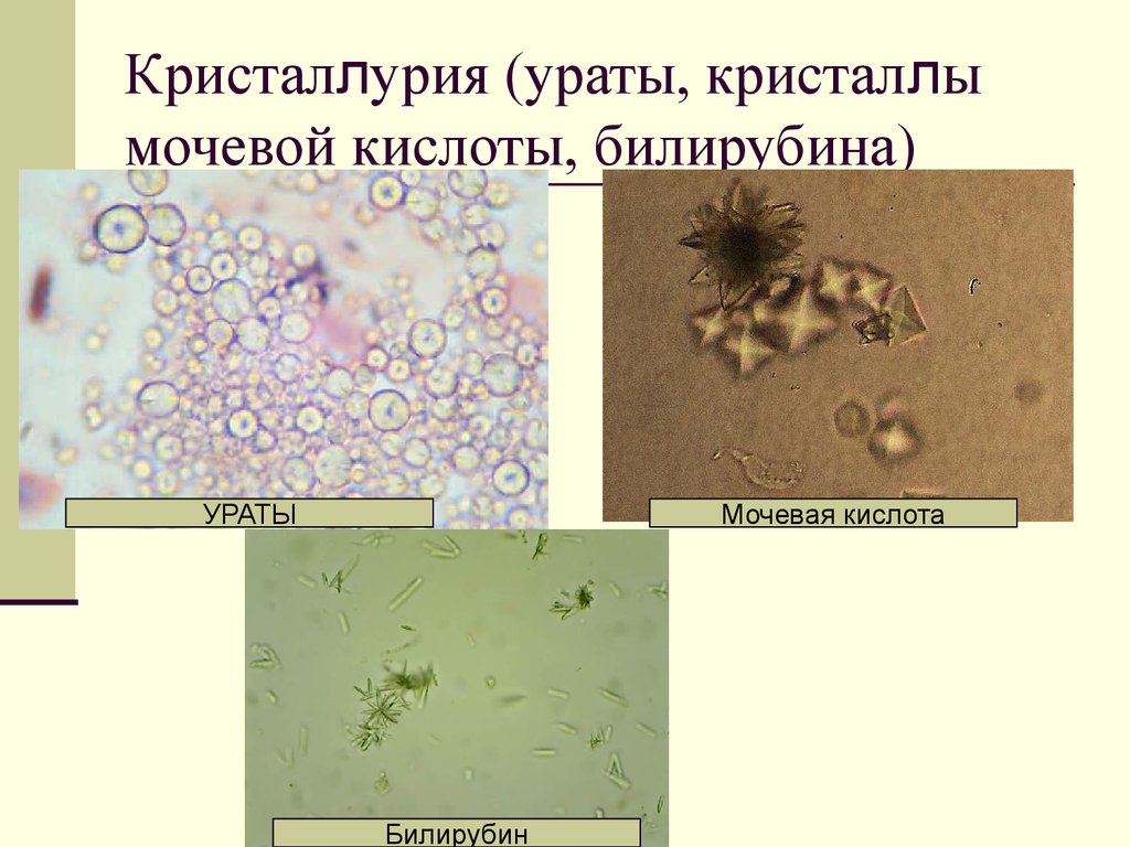 Кислота в моче. Ураты и соли мочевой кислоты. Ураты мочевая кислота. Кристаллы мочевой кислоты Ураты. Билирубин в моче микроскопия.