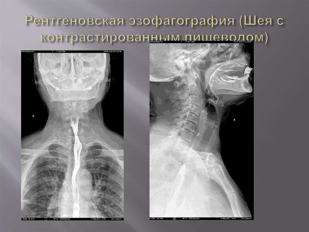 Пищевод зоб. Загрудинный зоб щитовидной железы рентген. Контрастирование пищевода барием. Рентген пищевода (эзофагография). Рентгенография пищевода с контрастом.