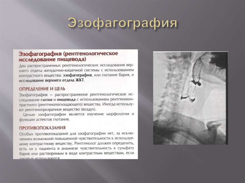 Пациенты барий. Контрастная эзофагография. Рентген пищевода (эзофагография). "Эзофагография" - это контрастное исследование пищевода.