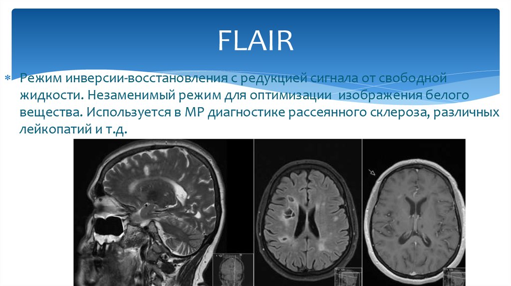 Т2 взвешенное изображение