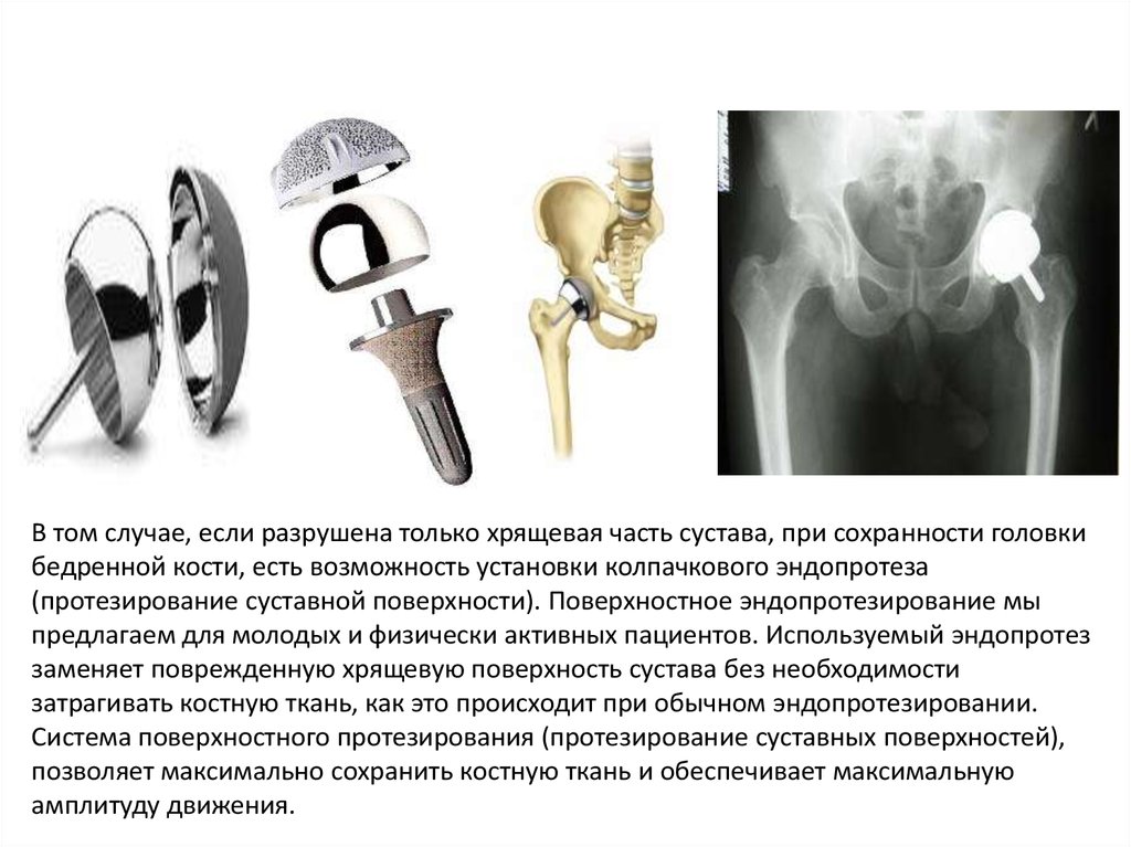 Эндопротезирование суставов презентация