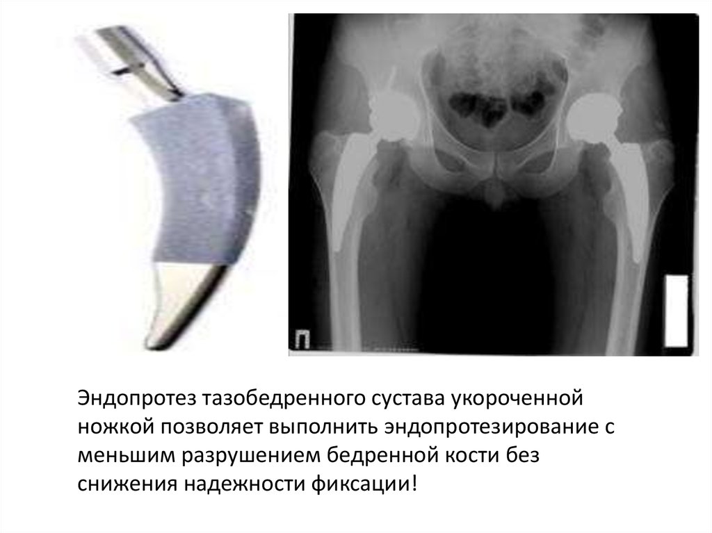 Эндопротезирование суставов презентация