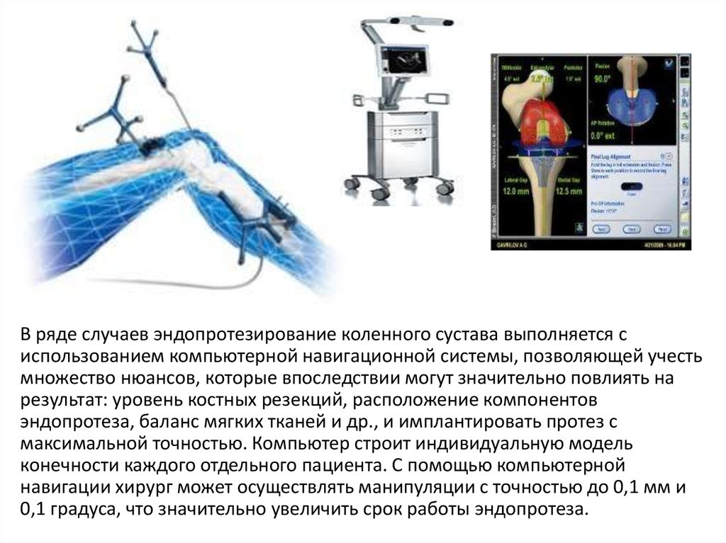 Эндопротезирование суставов презентация