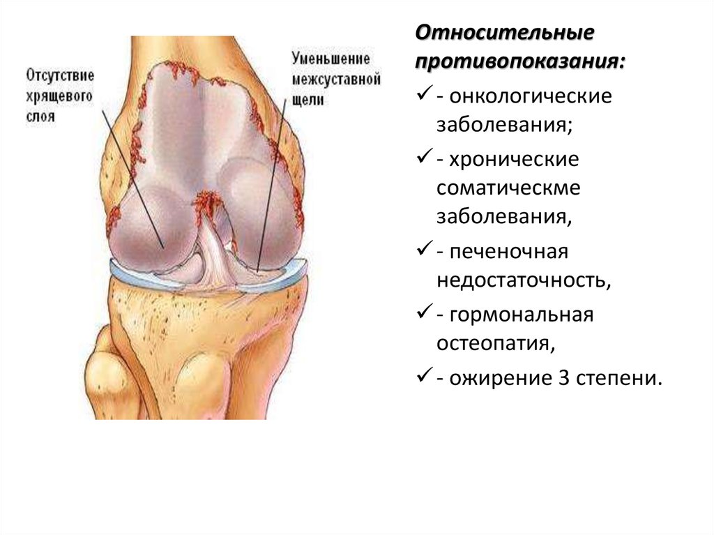 Эндопротезирование суставов презентация