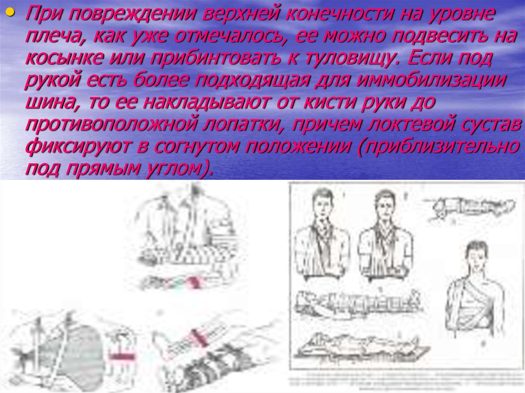 Травмы верхних конечностей презентация