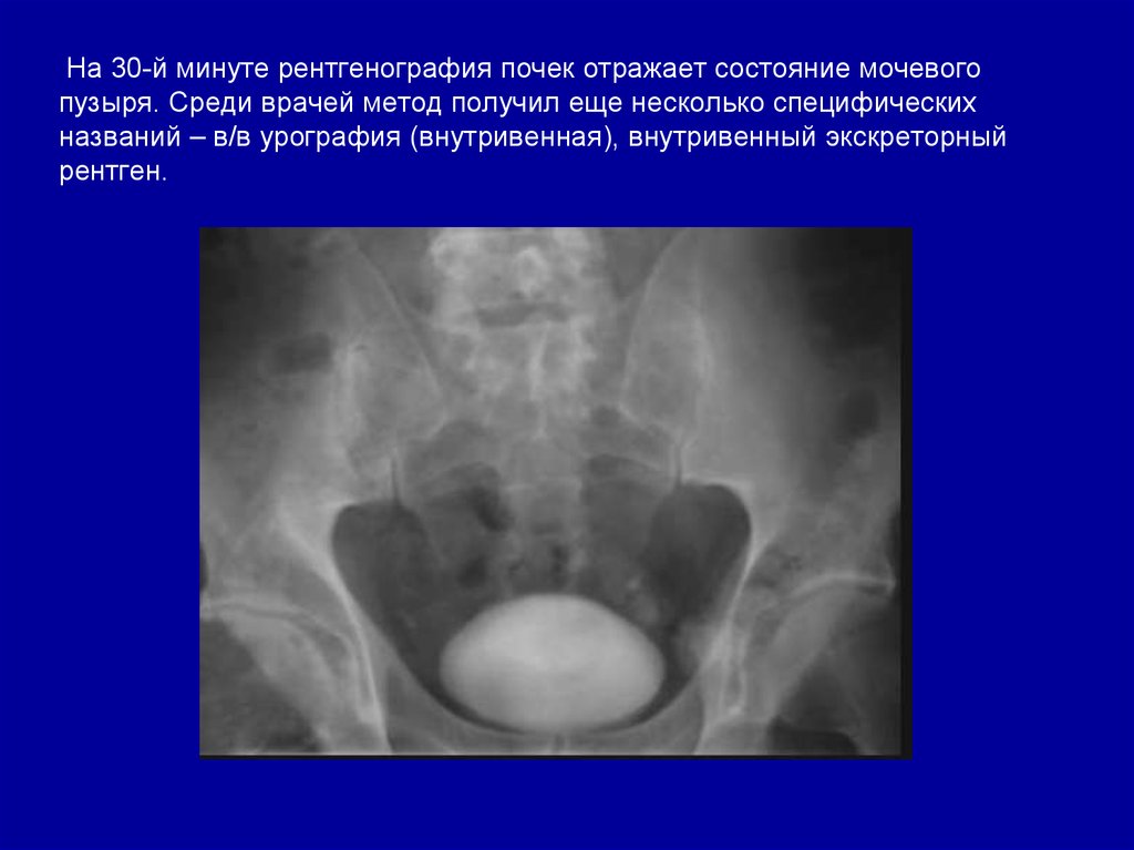 Цистография подготовка. Цистография мочевого пузыря рентген. Цистография опухоль мочевого пузыря рентген. Конкременты мочевого пузыря рентген. Цистография патология.