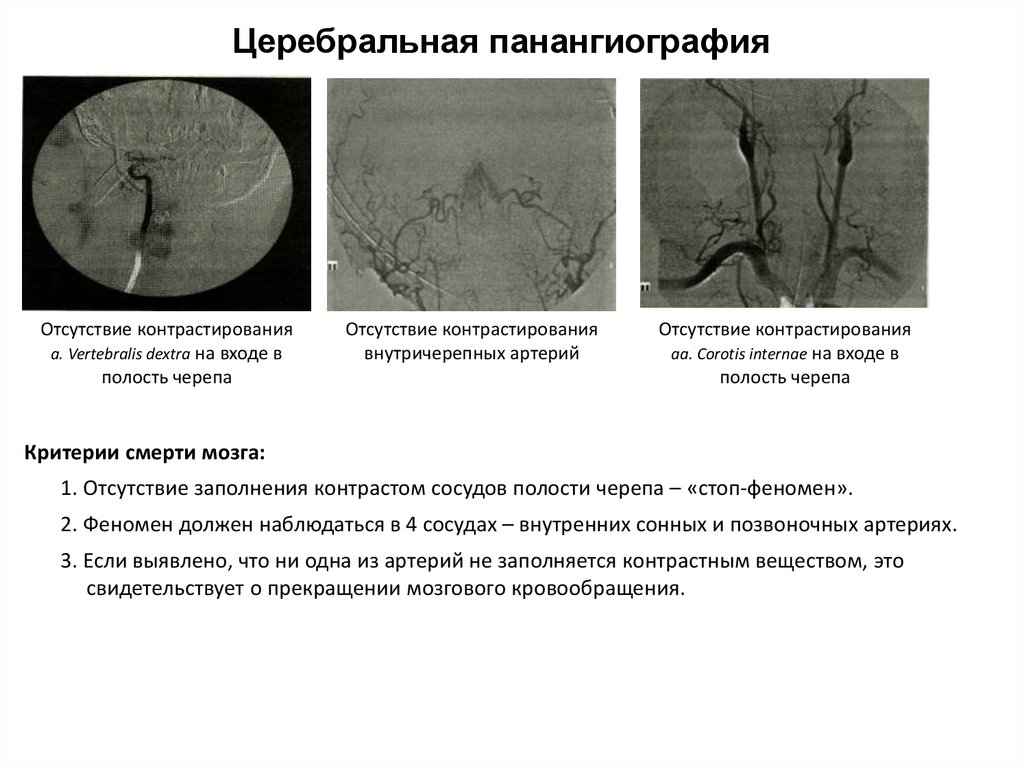 Смерть мозга презентация