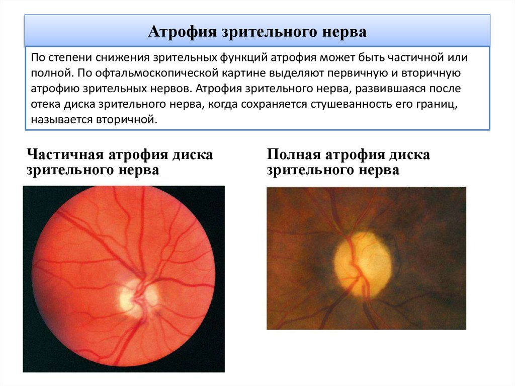Лечение глазного нерва. Клинические признаки поражения зрительного нерва. Врожденная атрофия зрительного нерва. Неврит зрительного нерва (воспаление зрительного нерва). Атрофия зрительного нерва Лебера.