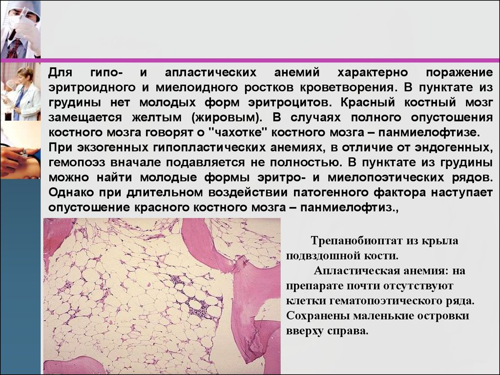 Пораженный костный мозг. Апластическая анемия красный костный мозг. Костный мозг при апластической анемии. Костный мозг при апластической анемии описание. Костный мозг при гипопластической анемии.