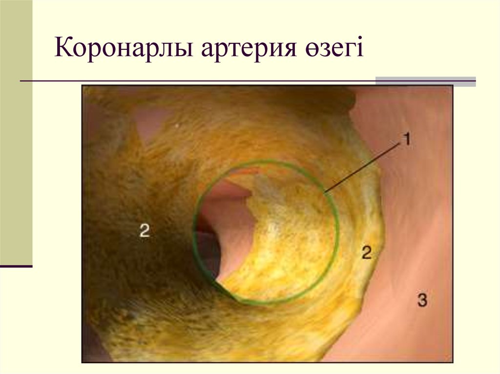 Коронарлы артерия өзегі