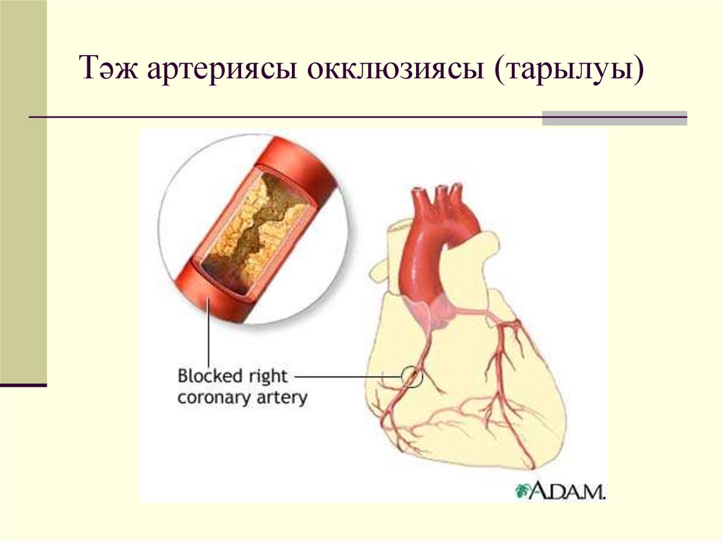 Тәж артериясы окклюзиясы (тарылуы)